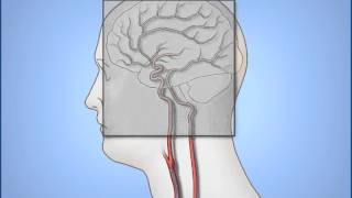 Diagnostic Cerebral Angiography [upl. by Shafer]