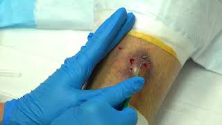 Thornys Leg Abscess Extended Raw Cut by MetaSeven [upl. by Minsk]