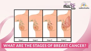 What are the stages of breast cancer [upl. by Zachery]