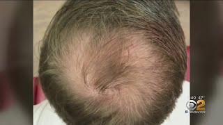 Can PRP Injections Spark Hair Growth [upl. by Mitzie347]