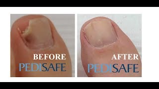 Black Toenail how to fix broken toenail safely [upl. by Maryellen]