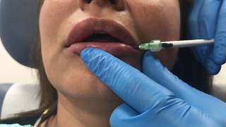 Reversing poorly placed lip filler using Hylenex hyaluronidase [upl. by Latrina]