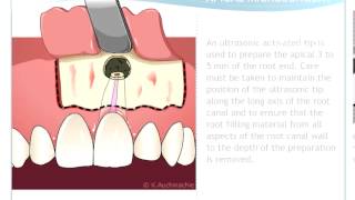 Endodontic Microsurgery [upl. by Suisyola256]