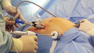 What are the advantages of a robotic surgery [upl. by Eenitsed]