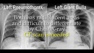 Pneumothorax vs Bulla in Chest X ray [upl. by Erodavlas]