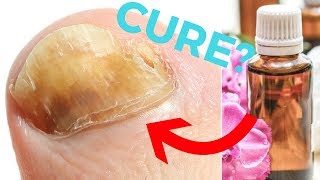 Fast Toenail Fungus Cure  How to Get Rid of Toenail Fungus With Nail Fungus Treatment [upl. by Wall265]