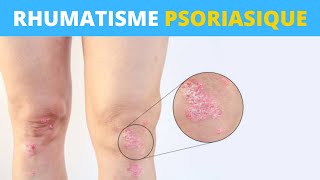 Le rhumatisme psoriasique expliqué en 1 minute [upl. by Datnow]