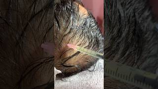 🩷 PRP HAIR TREATMENT alopecia aestheticclinic prp microneedling [upl. by Hatch]