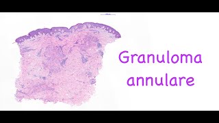 Granuloma annulare [upl. by Amalita]