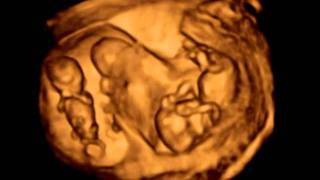 3D ultrasound Dichorionic triamniotic triplets 12 weeks [upl. by Anotyad]