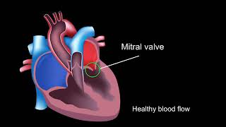 Physiology of rheumatic heart disease [upl. by Joshi]