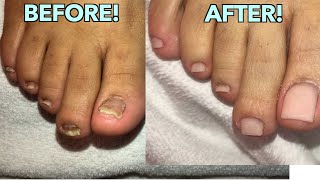 ACRYLIC TOES TUTORIAL DAMAGED TOENAIL  NO TIPS NATURAL OVERLAY [upl. by Ahsikit]