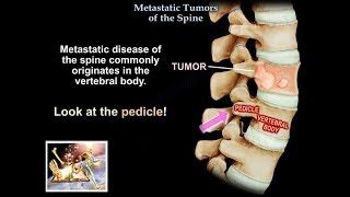 Metastatic Tumors Of The Spine  Everything You Need To Know  Dr Nabil Ebraheim [upl. by Radu]