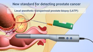 Transperineal Prostate Biopsies Under Local Anesthesia [upl. by Hukill854]