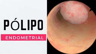 COMO SE TRATA UM PÓLIPO ENDOMETRIAL [upl. by Boleslaw]