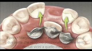 dott Montironi dentista  PONTE MARYLAND [upl. by Natascha]