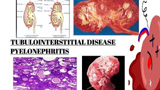 PYELONEPHRITIS  TUBULOINTERSTITIAL DISEASE PART 2  IMAGES  MCQs [upl. by Keating64]