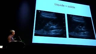 ECHOGRAPHIE ET ESTOMAC EN ANESTHESIE [upl. by Shwalb]