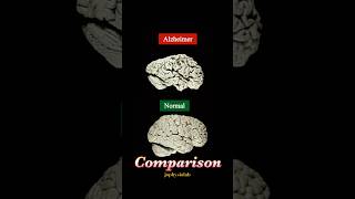 Alzheimer’s Dementia vs Normal Brain  PET scan  Neurology [upl. by Leizar523]