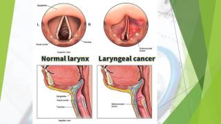 Laryngeal Cancer [upl. by Imac783]