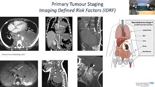 quotMolecular Imaging of Neuroblastomaquot by Dr Lorenzo Biassoni [upl. by Ordnaxela]