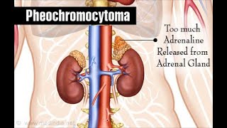 Pheochromocytoma Symptoms Pathophysiology Diagnosis and Treatment [upl. by Ardrey]