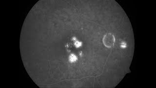 Fluorescein Angiography Phases [upl. by Derron]