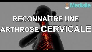 Reconnaître une arthrose cervicale [upl. by Claribel]