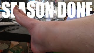 BROKEN ANKLE  SKIING INJURY  COURCHEVEL VLOG S3E19 [upl. by Limhaj]