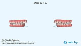 Increased overjet correction by Invisalign by Sphinx Orthodontics [upl. by Aitel]