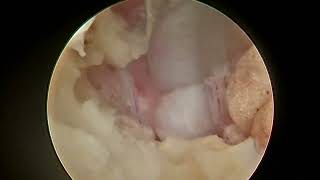 Intralaminar monoportal endoscopy 1080p30 [upl. by Eceinaj]