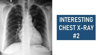 Interesting Chest Xray 2  Accessory Left Horizontal Fissure [upl. by Airlia257]