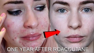 ONE YEAR AFTER ROACCUTANE  MY SKIN NOW [upl. by Andrade]