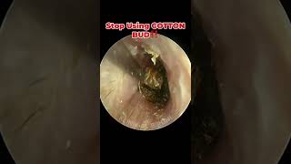 Deep Impacted Cerumen With Severely Swollen Ear Canal [upl. by Eirruc937]