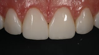 Resin Veneering and Freehand Diastema Closure [upl. by Airyk1]