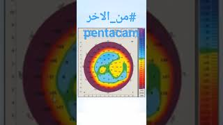 منالاخر pentacam [upl. by Kendra]