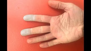 Raynaud’s syndrome Symptoms – Causes Treatment Pictures Signs and Symptoms of Raynaud’s syndrome [upl. by Madian]