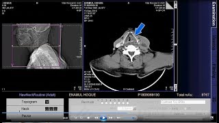 CT scan of larynx and hypopharynx Neck format [upl. by Thin163]