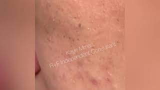 RodanFields Pore Tool For Blackhead Removal [upl. by Barina]