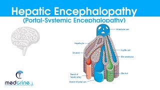 Hepatic Encephalopathy portal systemic encephalopathy causes classification featuresDX and rx [upl. by Aralk]