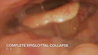 DISE  epiglottal collapse [upl. by Ianthe856]