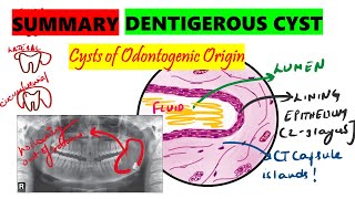 Dentigerous cyst  10 minute SUMMARY  Histopathology  Clinical features  Radiographic features [upl. by Martineau]