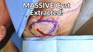 skibidi toilet rizzler gyatt and the BIGGEST cyst extraction [upl. by Nylrats204]