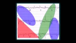 The 12 Lead EKG What Leads Look Where [upl. by Adina]