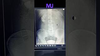 Intra venous urogram  pyelogram  radiological xray medicalimaging doctor anatomy [upl. by Nero732]