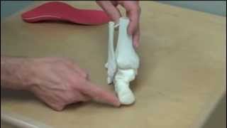 Supinated Foot  Foot Orthotic [upl. by Gold]