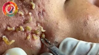 Ultimate Pimple Popping 2024 Satisfying Blackhead Extractions amp Acne Solutions [upl. by Asirret988]