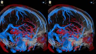 Arteriovenous Malformation AVM  3D Virtual Tour  UCLA Neurosurgery [upl. by Llerrom]