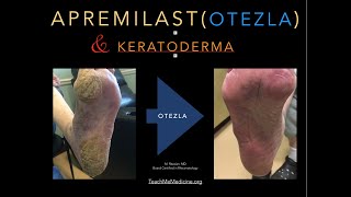 Apremilast Otezla and Keratoderma [upl. by Suolevram]