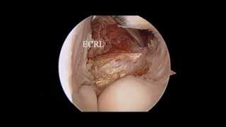 Elbow Arthroscopy  Tennis Elbow  Nicky Leung MD [upl. by Kumar589]